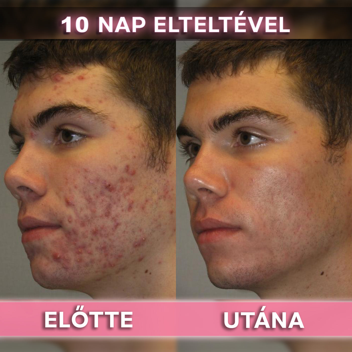 AkneMax (Extrém gyorsan, napok alatt eltünteti az aknét, pattanást és a mitesszert)