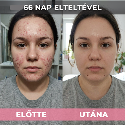 AkneMax (Extrém gyorsan, napok alatt eltünteti az aknét, pattanást és a mitesszert)