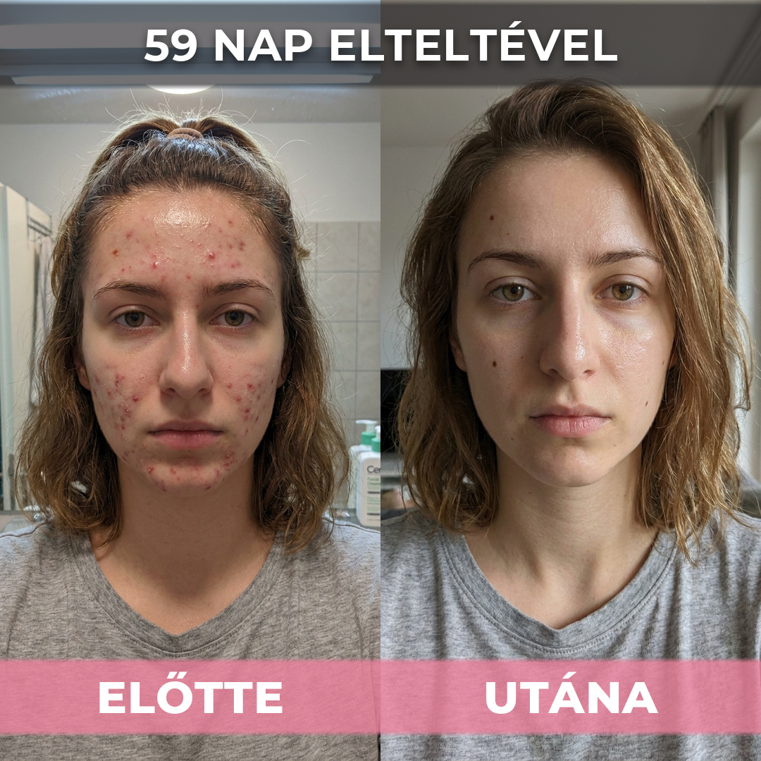 AkneMax (Extrém gyorsan, napok alatt eltünteti az aknét, pattanást és a mitesszert)