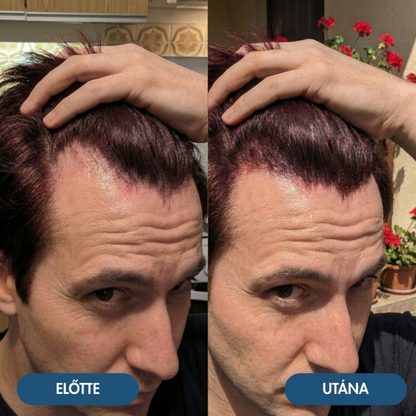 4db USA Hair Elixir Férfiaknak - Extrém Hatékonyan Beindítja A Hajnövekedést & Megállítja A Hajhullást