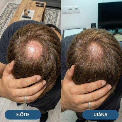 4db USA Hair Elixir Férfiaknak - Extrém Hatékonyan Beindítja A Hajnövekedést & Megállítja A Hajhullást