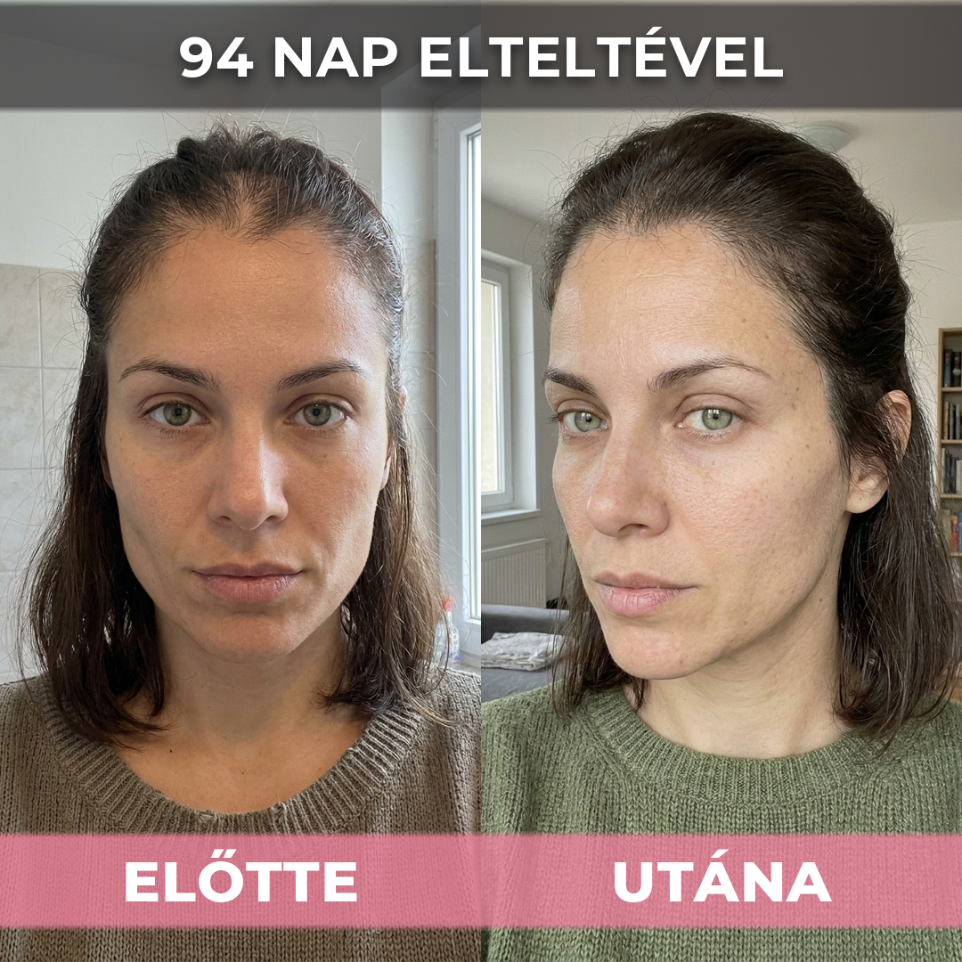 2db USA Hair Elixir Nőknek - Extrém Hatékonyan Beindítja A Hajnövekedést & Megállítja A Hajhullást